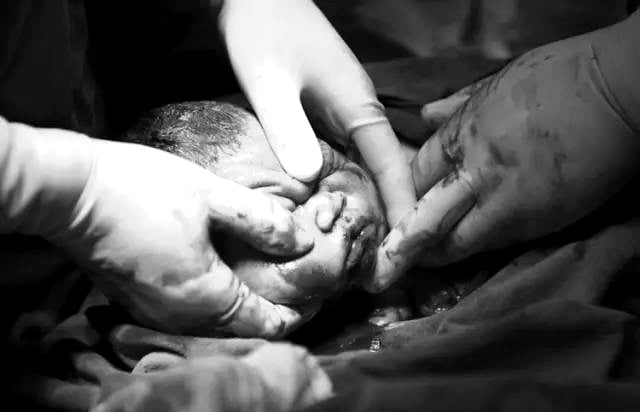 Bác sĩ sẽ đẩy nhẹ lên bụng sản phụ, từ từ đưa đầu em bé rồi đến phần Sh88bet đăng ký miễn phí ra ngoài.