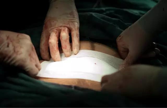 Sau mổ bác sĩ dùng băng gạc dán vào miệng vết thương để tránh nhiễm trùng. Đến đây, một ca sinh mổ coi như thành công.