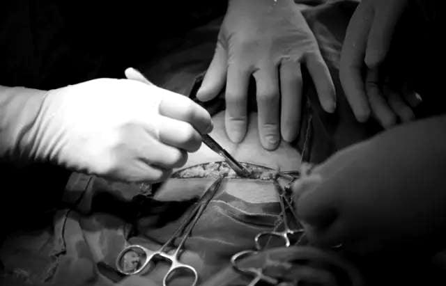 Sau vết rạch biểu bì trên cùng, các bác sĩ sẽ từ từ mở từng lớp ở phía dưới. Phải qua đến 7 lớp da bụng thì mới có thể tạo lối để đưa em bé ra ngoài.