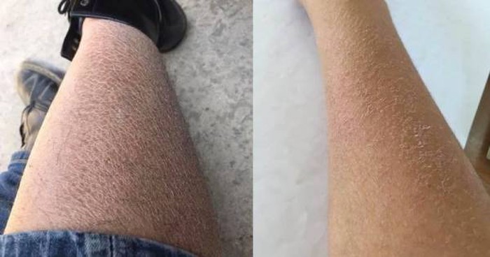 Vào mùa đông, da rất dễ bị khô, nẻ.