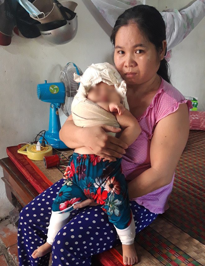 Bé C. được băng bó cố định tay phải.