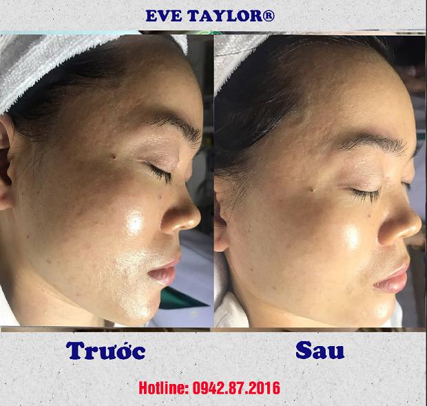 Khách hàng trước và sau khi sử dụng dịch vụ Eve Taylor®  