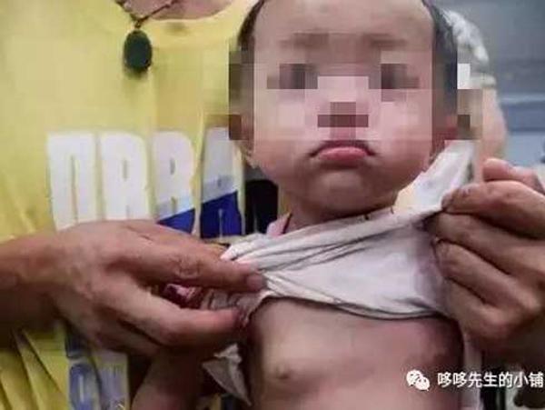 Bé gái 2 tuổi có vòng 1 to bất thường