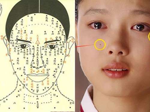 Nốt ruồi ở lệ dường số khổ