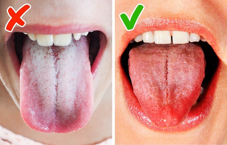 Lớp phủ mỏng màu trắng trên lưỡi có thể là dấu hiệu Sh88bet đăng ký miễn phí đang thiếu sắt hoặc vitamin B.    