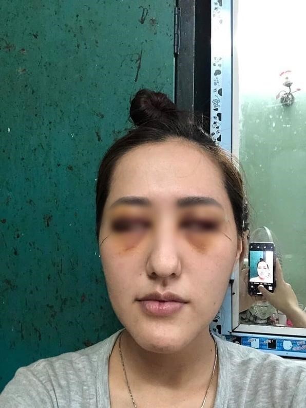Lý Kim Ng sau khi Shbet888 tiền thưởng cực khủng cắt mí lần đầu tiên.