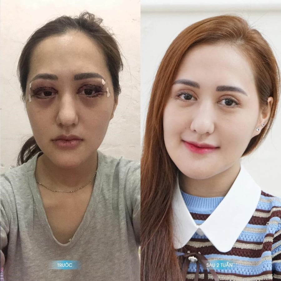 Ng trước và sau khi tái Shbet888 tiền thưởng cực khủng tại Viện Shbet888 tiền thưởng cực khủng thẩm mỹ Plasma.