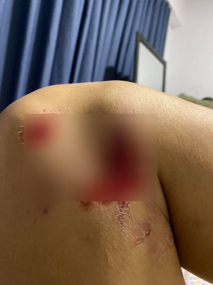 Chồng cũ Ngọc Lan chia sẻ cận cảnh vết thương khi được bạn bè hỏi thăm.