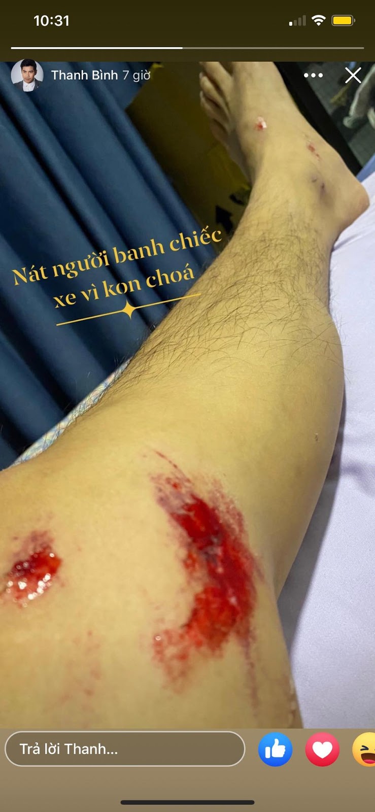 Mới đây, Thanh Bình khiến người hâm mộ lo lắng khi đăng bức ảnh anh nằm viện với nhiều vết thương ở chân. Theo như nam diễn viên chia sẻ thì anh bị tai nạn xe nghiêm trọng, phương tiện đi lại bị hư hỏng nặng. Nguyên nhân được biết là từ một con chó gây ra. Nhiều khán giả đoán rằng, anh né một con chó chạy ngang đường sau đó mất tay lái và ngã xuống đường khiến người bị thương nặng và xe bị hư hỏng.    