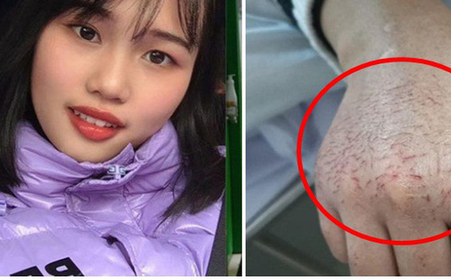 Chân dung của nữ y tá xinh đẹp Hu Pei và đôi bàn tay nứt nẻ của cô