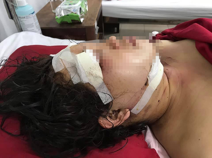 Chị M. đang được điều trị tại bệnh viện trong tình trạng trọng thương. 