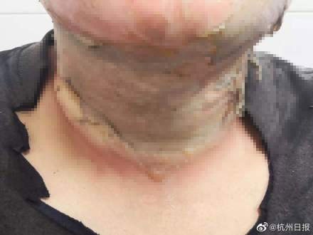 Vết bỏng ở cổ người đàn ông.