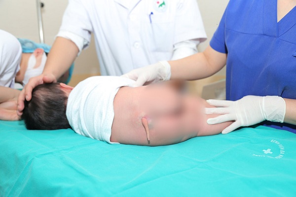 Bệnh nhi 5 tháng tuổi được Shbet888 tiền thưởng cực khủng cắt bỏ chiếc đuôi bẩm sinh. (Ảnh: PV/Vietnam+)