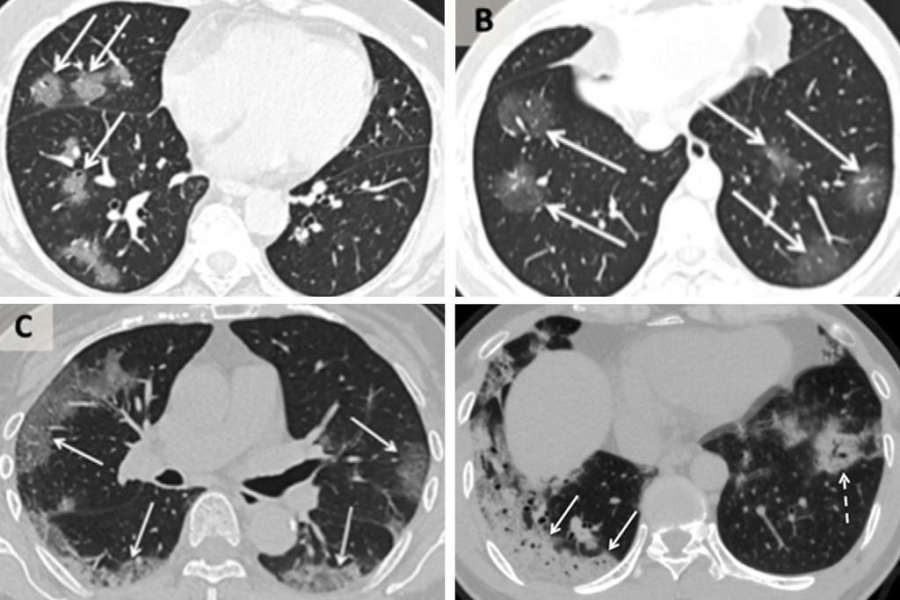 Ảnh chụp CT của các bệnh nhân Trung Quốc bị nhiễm virus corona. Theo chiều kim đồng hồ từ trên cùng bên trái, một phụ nữ 56 tuổi, một nam 44 tuổi, một nam 42 tuổi và một nữ 65 tuổi.
