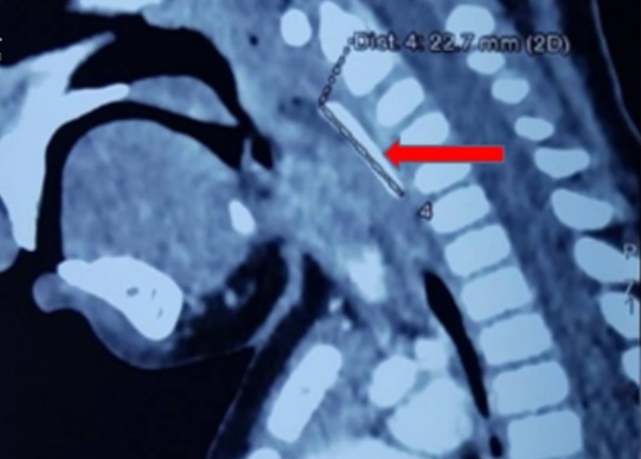 Ảnh chụp CT-scan vùng cổ của bệnh nhi.