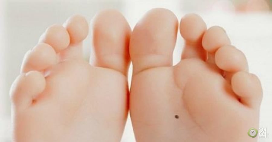 Lòng bàn chân có nốt ruồi số phú quý phát tài