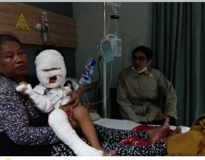 Bé gái 3 tuổi bị bỏng nặng vì cầm lọ nước rửa tay khô đến gần lửa.