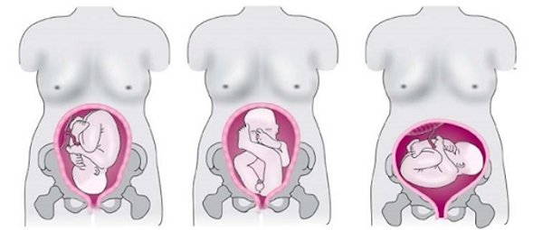 Một số dạng ngôi thai bất thường