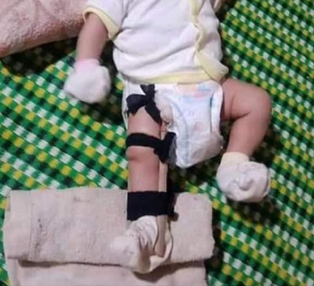Cháu bé 2 tháng tuổi bị gãy chân, nghi do cha ruột bạo hành. Sự việc được chia sẻ trên mạng xã hội và đang được rất nhiều người quan tâm.