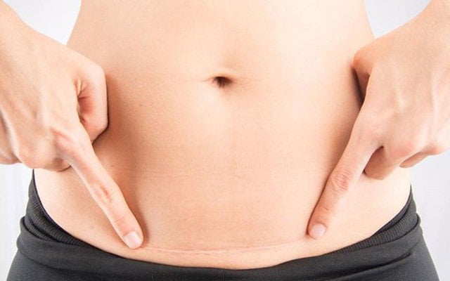 Tác hại khi bạn sinh mổ
