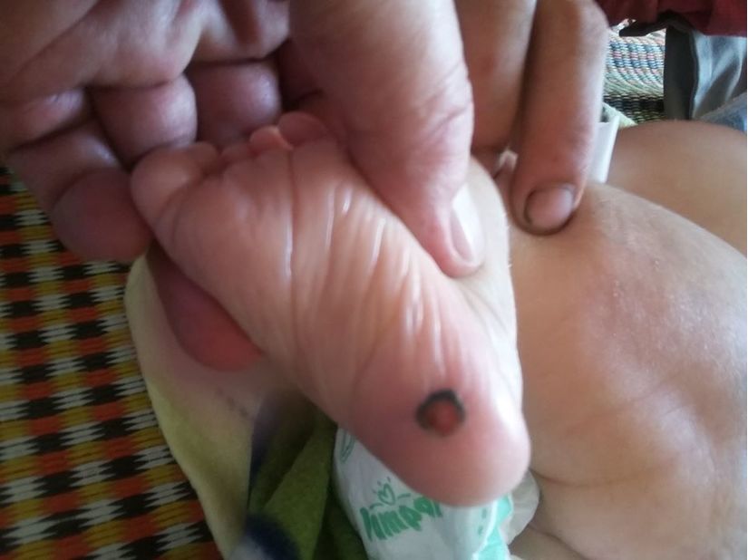 Bé nhập viện với vết loét ở chân và mông.