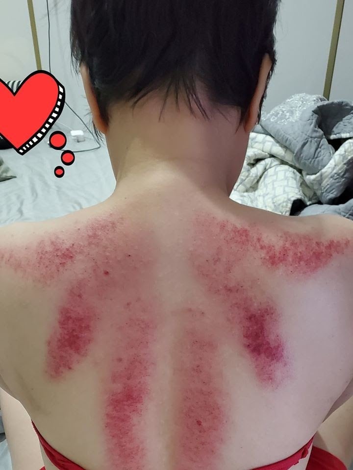 Việt Hương gọi vui những vết bầm này trông như bông hoa.