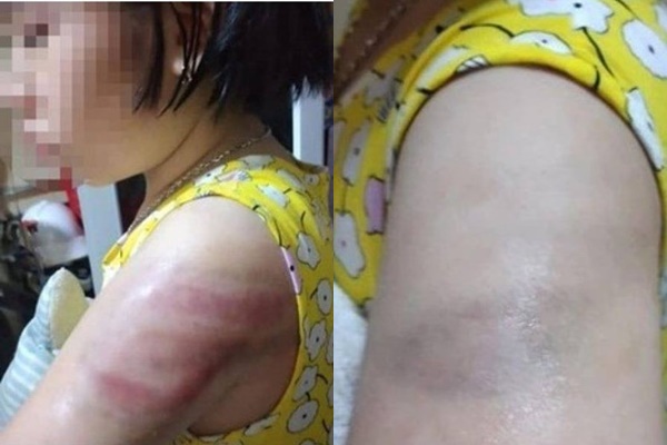 Hình ảnh bé gái bị đánh bầm tím cánh tay.