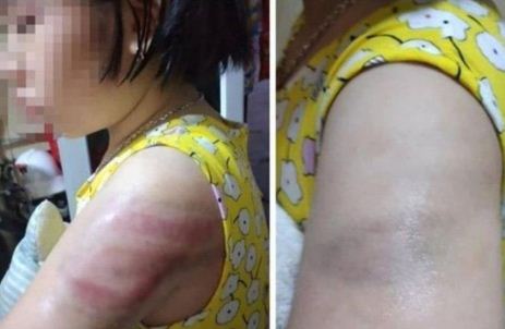 Phần cánh tay của em T. bầm tím sau khi bị cô giáo đánh.