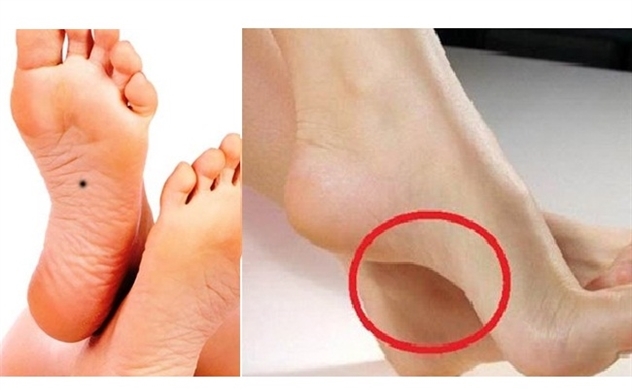 Tướng bàn chân là hố chôn tiền