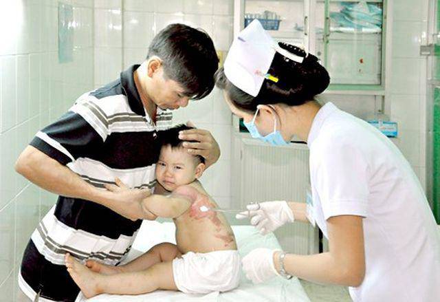 Bé trai 17 tháng bị bỏng mẹ sơ cứu đúng cách
