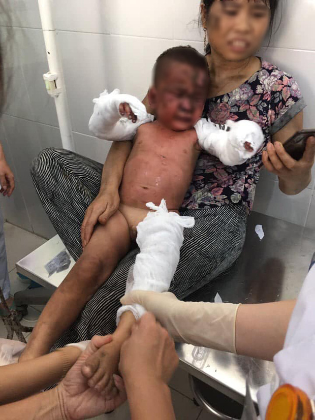 Các cháu được đưa vào bệnh viện trong tình trạng bỏng nặng