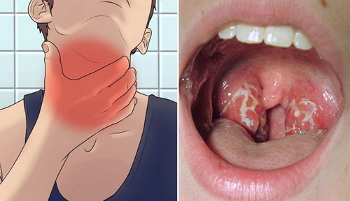 Nhiều đối tượng dễ mắc bệnh bạch hầu