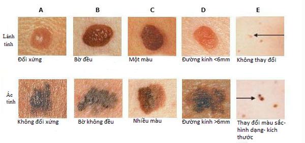 6-dau-hieu-cua-not-ruoi-ac-tinh-01