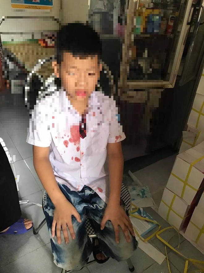 Em N.G.K. sau khi bị Đức hành hung. Ảnh: Hóng biến Hòa Bình.