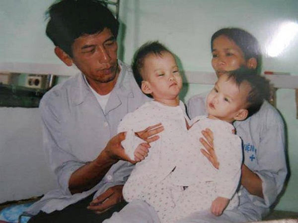 Cặp song sinh dính liền Cúc- An lúc nhỏ