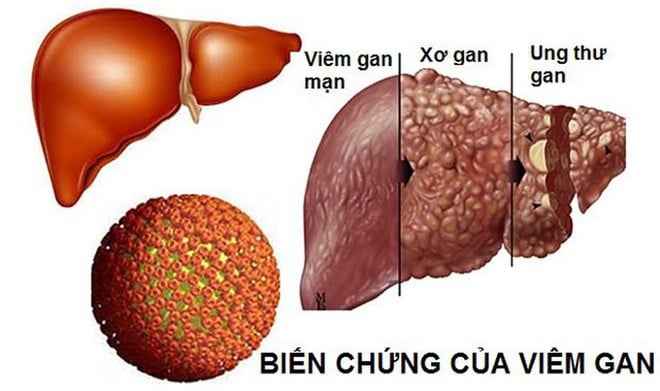 Tỷ lệ mắc ung thư gan cao dần lên theo tuổi tác, đặc biệt là nhóm người ở tuổi 40