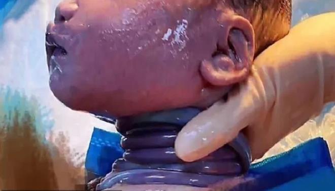 Bé trai chào đời khỏe dù bị dây rốn quấn tới 6 vòng quanh cổ.