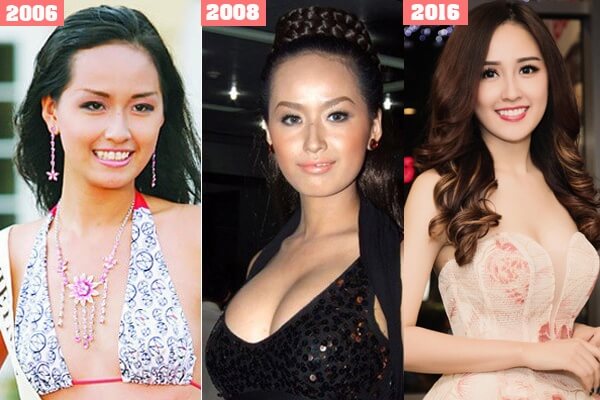 Hình ảnh rõ rệt cho thấy Mai Phương Thúy có thể đã can thiệp dao kéo vòng 1.