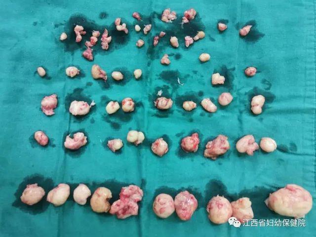 Bác sĩ bóc tách thành công nhiều khối u xơ lớn nhỏ trong tử cung của nữ bệnh nhân 27 tuổi.