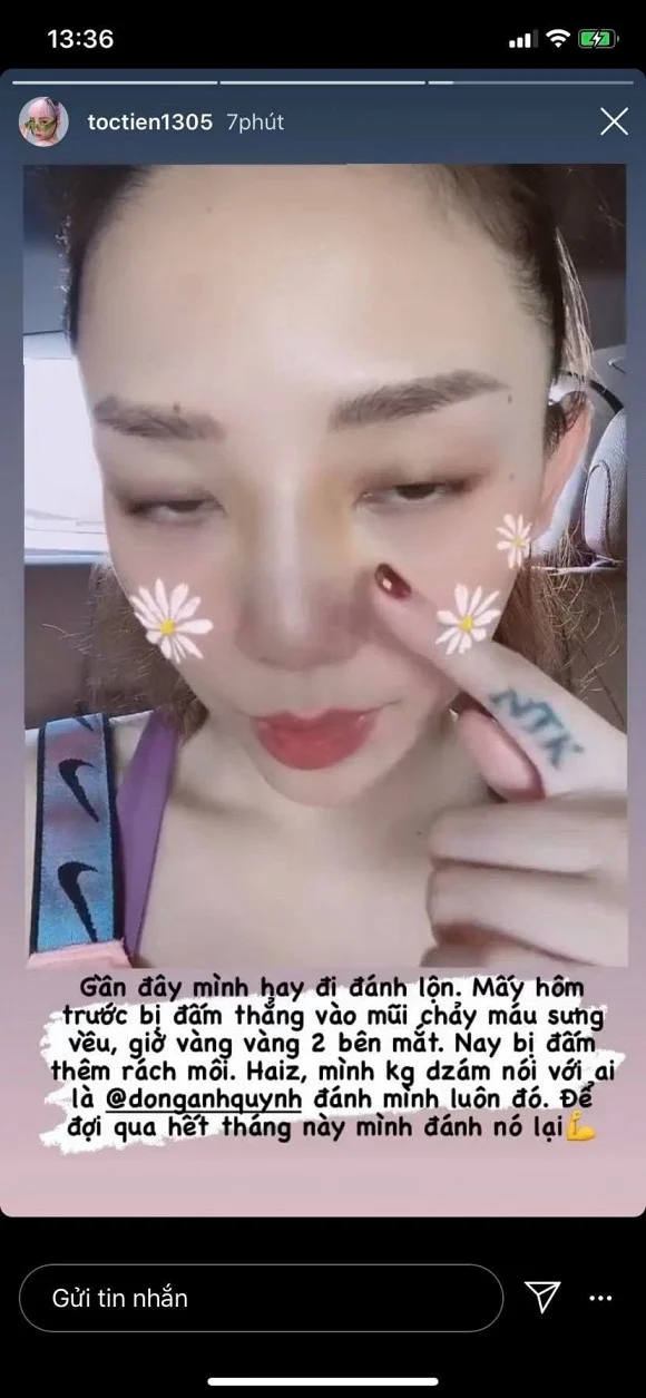 Mới đây Tóc Tiên bất ngờ chia sẻ hình ảnh bị chấn thương trong quá trình tập luyện đến mức sưng mũi, rách môi. Và chẳng ai khác người bạn tập của cô - nữ người mẫu Đồng Ánh Quỳnh lại chính là thủ phạm. Hơn nữa cô còn khéo dùng động tác vặn mũi để chứng minh đẹp tự nhiên, không hề chỉnh sửa. Nhìn khoảnh khắc này, ai cũng nhắn nhủ nữ ca sĩ nên dành thời gian nghỉ ngơi nhiều hơn.