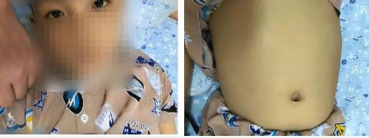 Cậu bé nhập viện trong tình trạng da vàng bất thường.