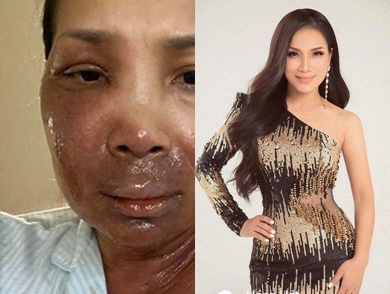 Gương mặt Hồng Ngọc bị bỏng, phải tạm dừng mọi hoạt động nghệ thuật.