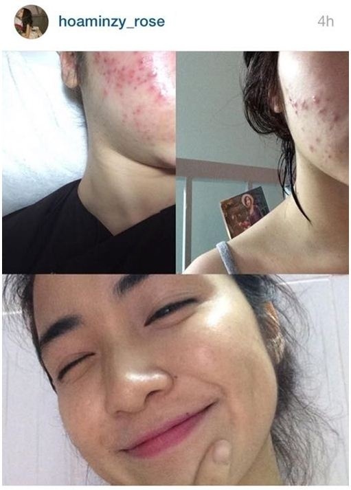 thi-ra-rau-diep-ca-nuoc-dua-la-cuu-tinh-giup-hoa-minzy-thoat-mun-777202e2