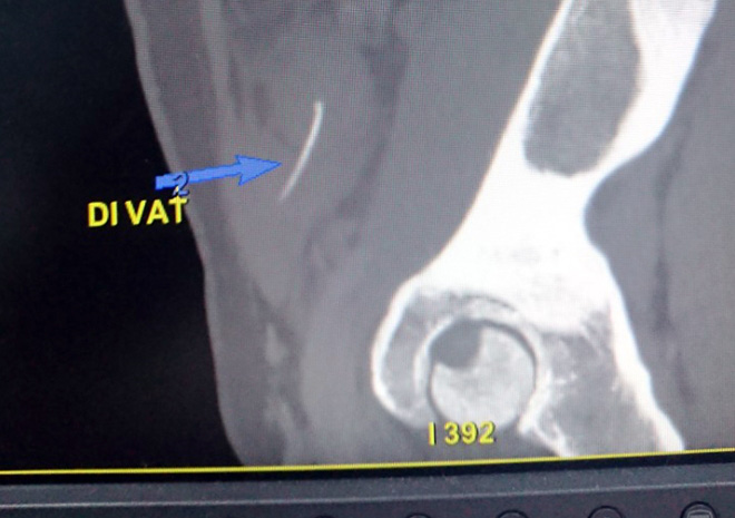 Kết quả chụp CT của bệnh nhân