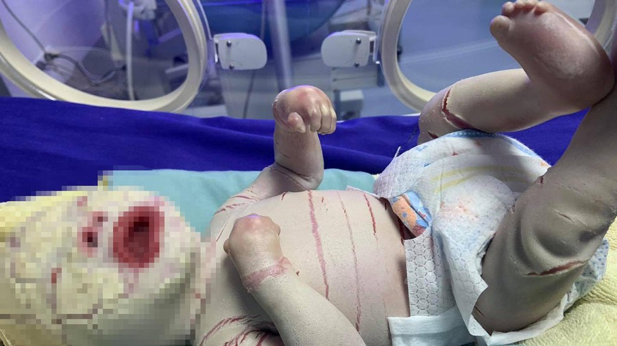 Bé sơ sinh mắc bệnh hiếm gặp với lớp da trắng dày bao phủ, nứt thành kẽ sâu