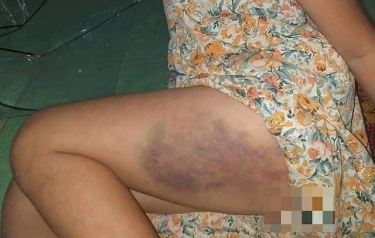 Vết bầm tím trên đùi của cháu bé