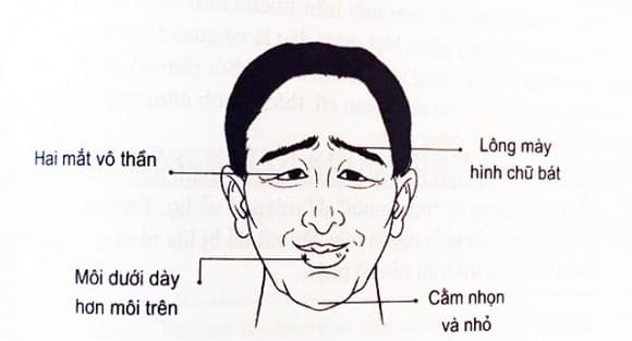 Đàn ông tướng trán thấp nghèo khổ
