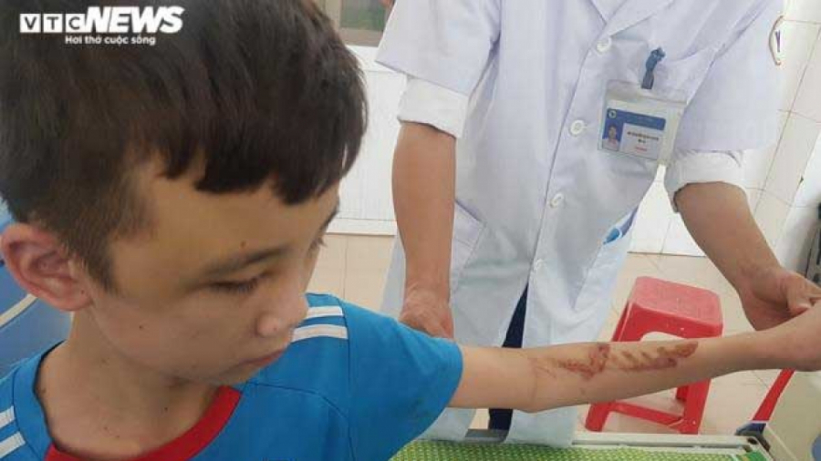 Cậu bé 14 tuổi bị chủ quán bánh xèo bạo hành với chi chít vết thương trên người, mặt bầm tím. Ảnh VTC News  