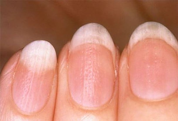 Bắt bệnh qua móng tay