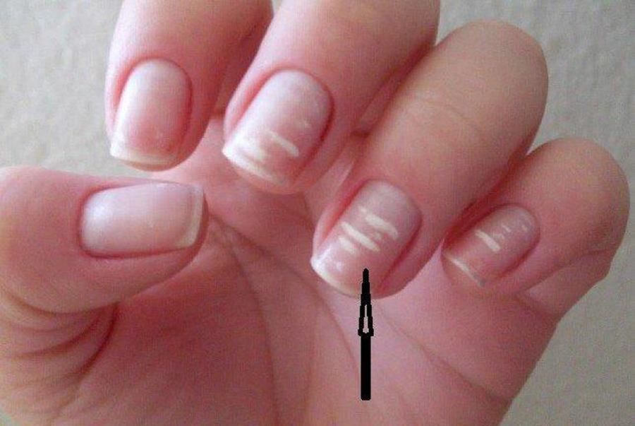 Nhìn vào móng tay biết bệnh